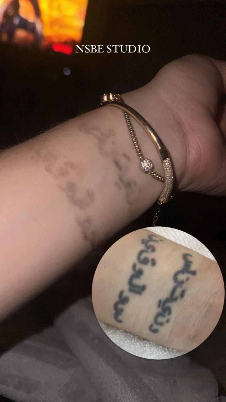 Resultado de remoción de tatuaje en una muñeca, con el tatuaje desvanecido y una vista circular del antes